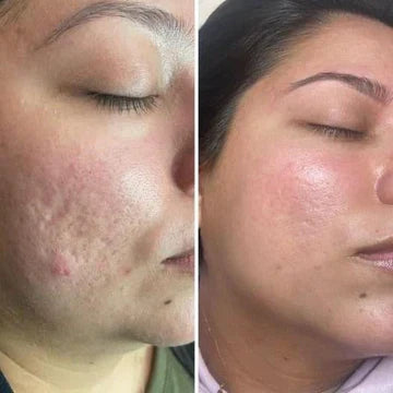 Silicone Scar Sheets - Fade What You Don’t Want Seen