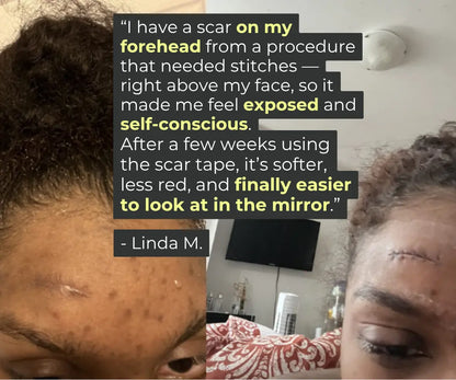 Silicone Scar Sheets - Fade What You Don’t Want Seen